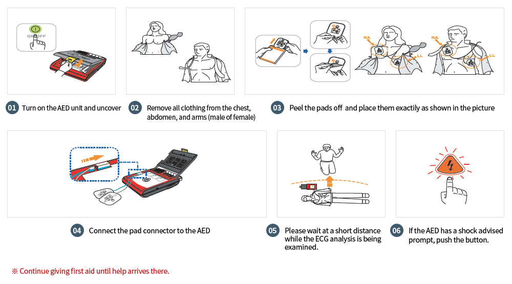 1. Turn on the AED unit and uncover, 2. Remove all clothing from the chest, abdomen, and arms (male or female), 3. Peel the pads off and place them exactly as shown in the picture, 4. Connect the pad connector to the AED, 5. Please wait at a short distance while the ECG analysis is being examined. 6. If the AED has a shock advised prompt, push the button. ※Continue giving first aid until help arrives there.